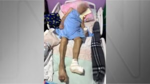 Idosa de 103 anos tem pé amputado por enfermeira sem anestesia