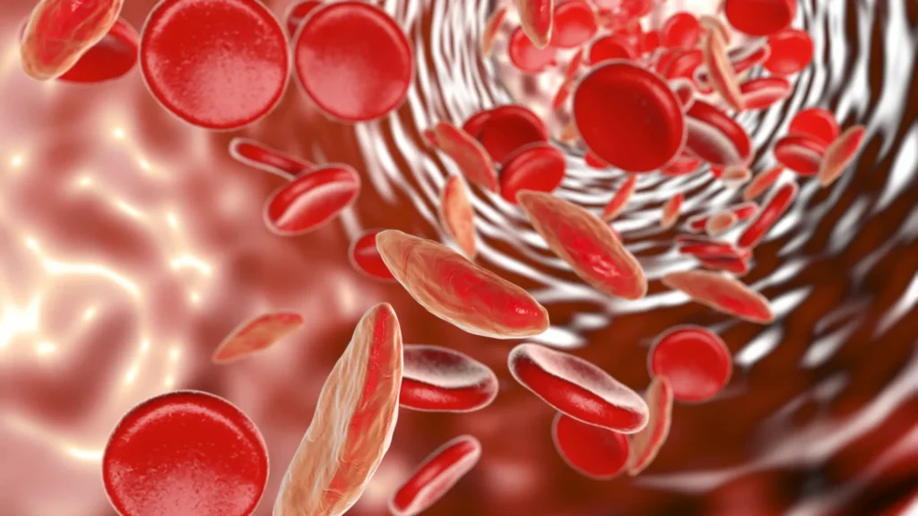 Sabe o que é anemia falciforme ou drepanocitose? Saiba os sintomas