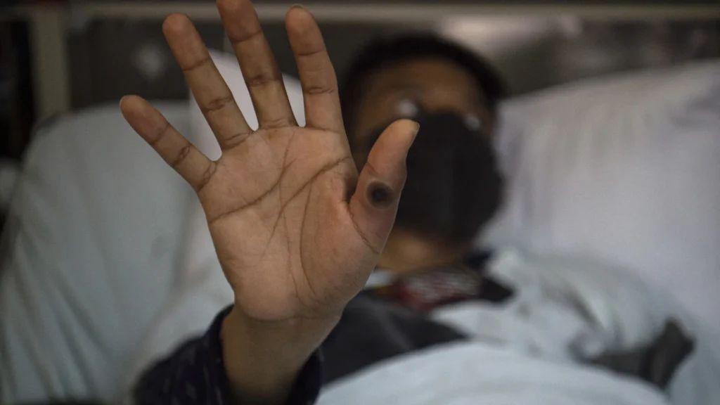 Mpox: África tem quase 50 mil casos confirmados