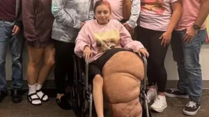 Garota de 14 anos passa por cirurgia de 17h para remover a perna de 79kg