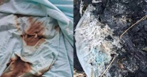 TJPA deferiu medida protetiva dois dias antes de mulher ser queimada pelo companheiro em Salinópolis