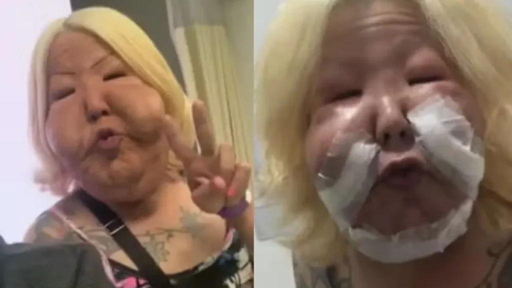 Juju do Pix se recupera após segunda cirurgia para retirar óleo mineral do rosto, médico Thiago Marra mostra imagens 145 news 2672 1769713432